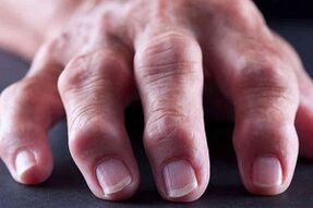 Die Hauptunterschiede bei Arthritis und Arthrose