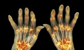 Was ist der Unterschied zwischen Arthritis durch Arthrose der Gelenke