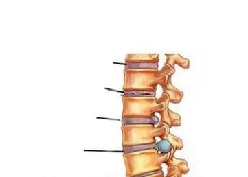 Vier Phasen der Osteochondoseentwicklung